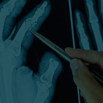 closeup-of-x-ray-filmof-a-fractured-finger-PQ6CM5E